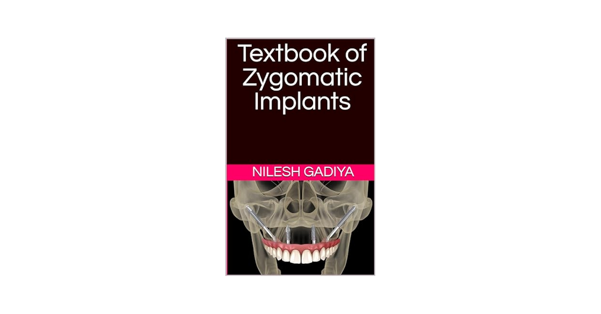 Amazon.com: Textbook of Zygomatic Implants eBook : Gadiya